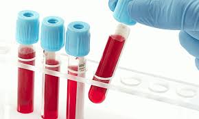 images 7 تحليل FNS - أهم تحليل للدم تعرف على رموزه وقيمه الطبيعية